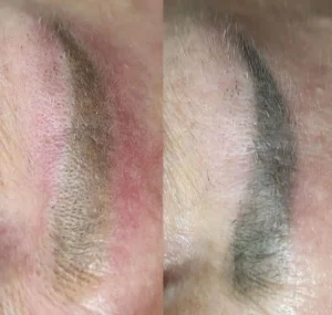 Risks and Side Effects of Laser Eyebrow Tattoo Removal Procedure