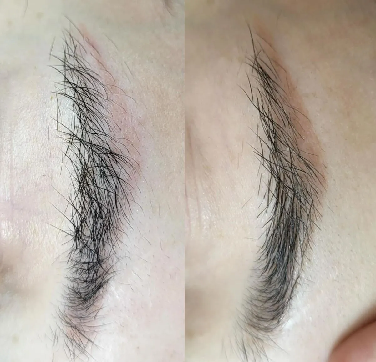 eyebrow laser tattoo removal